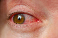 特写镜头刺激感染的红血眼, 结膜炎.