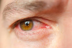 特写镜头刺激感染的红血眼, 结膜炎.