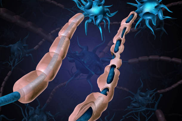 多发性硬化症损害髓鞘或自身免疫性疾病与健康的神经与暴露的纤维与扫描细胞鞘损失作为一个3d 例证.
