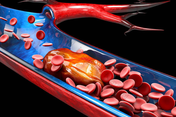 3d 深静脉血栓形成或血块的插图。栓塞