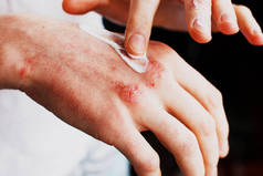 手上有湿疹在治疗湿疹、牛皮癣等皮肤病中使用药膏、面霜的男子。皮肤问题的概念