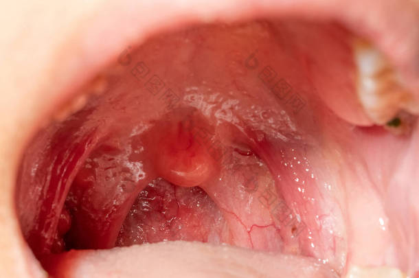 喉咙疼痛, 喉咙肿胀。闭合张开嘴与后咽壁肿胀和外阴和扁桃体。咽后壁的流感滤泡。上呼吸道.