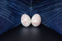 白蛋--人的球的象征。精索静脉曲张-男性疾病导致男性不孕。危险泌尿系统疾病的概念。睾丸上的静脉曲张.