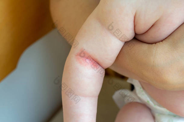 刺骨的热量。红色皮肤新生儿手部褶皱的特写.
