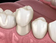 牙冠前牙组装过程。人体牙齿治疗的医学精确三维插图