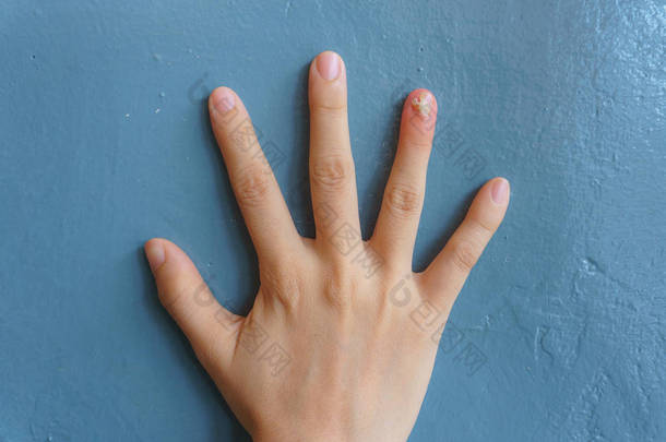 指甲真菌感染在无名指的特写。人手遭受真菌感染。奥尼丘霉菌病与真菌指甲感染在蓝色背景的指甲.