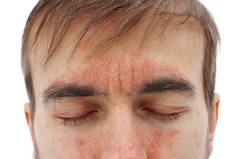 眼睛闭合的病头，皮肤有红色过敏反应，鼻子、额头和脸颊出现红红和剥皮，季节性皮肤问题，特写，白色背景