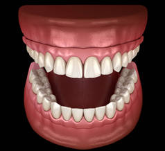 上颌骨和下颌骨假体均在4个系统上，由植入物支持。医学上准确的人类牙齿和假牙3D图像