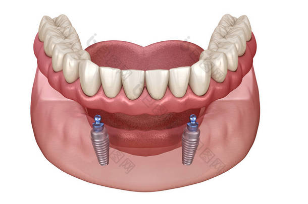 下颌骨可摘除假肢全部在2个系统上，由带有球状附着物的植入物支撑。医学上准确的牙科3D图像