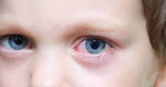 儿童眼睛中的结膜炎。 眼科疾病。 红眼 血管爆裂在眼睛里.