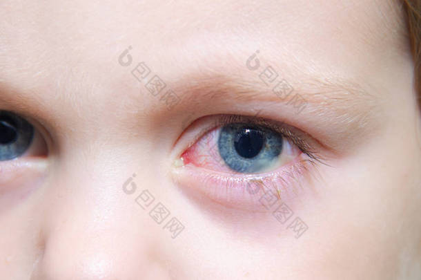 儿童眼睛中的结膜炎。 眼科疾病。 红眼 血管爆裂在眼睛里.