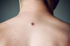 男性背部的纤维瘤，细节，特写