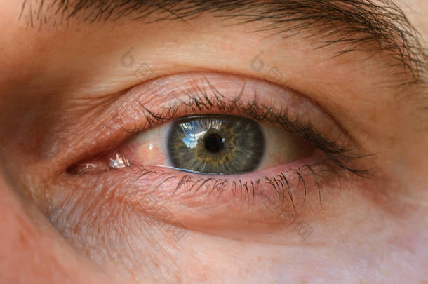 近视，明显表现结膜炎，眼部红肿.