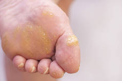 女人的脚上有花纹和玉米粒。 皮肤科疾病。 花生酱疣。 在与皮肤科医生的预约中。 浅色底纹的雌性脚.