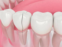 假牙下颌骨3D成形术