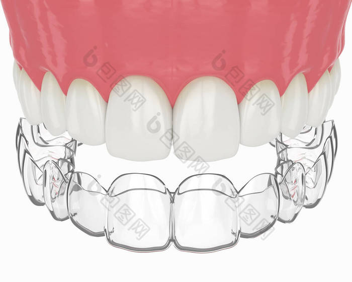 上下颌骨的三维渲染，在白色背景上具有渐变可摘可摘固位体