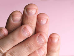 男性指甲上的白斑是由缺乏钙、锌或家庭化学品在粉色背景下造成的。这种病叫做白血病.