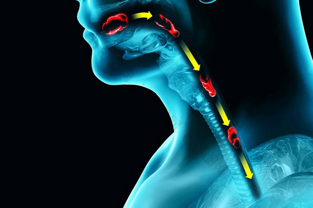 吞咽障碍，吞咽困难。 咽部和<strong>食管</strong>消化不良。 口述阶段。 食物的路径，吞咽的行为。 人通过X光，3D渲染。 吞咽涉及将唾液、固体食物和饮料从口中输送到胃里