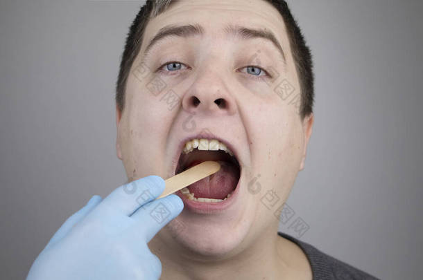 一位耳鼻喉科医生用木片检查一个人的喉咙。一个可能的诊断是咽部、扁桃体或咽炎的炎症。喉部疾病的治疗和预防概念