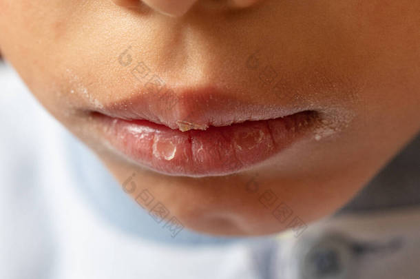 用干裂的嘴唇和裂开的皮肤捂住一个小男孩的嘴