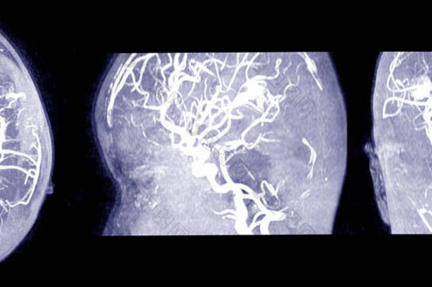 脑的MRI及MRA和MRV检查。中线移位至左侧0.7 cm的中周血管水肿.