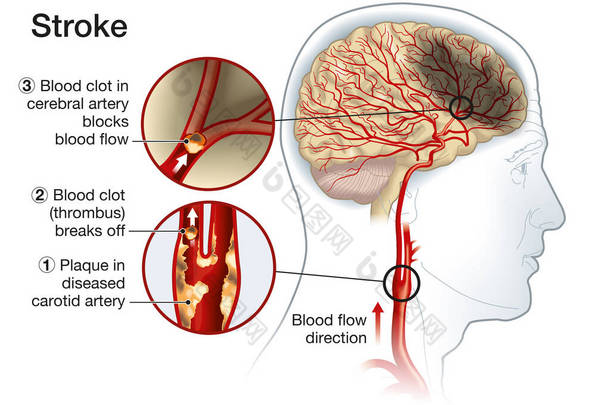 显示颈动脉斑块、血凝块破裂及血流阻塞的图例