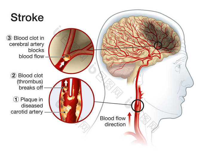 显示颈动脉斑块、血凝块破裂及血流阻塞的图例