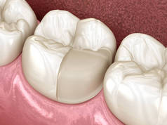 牙齿上镶嵌陶瓷冠的制备.医学上准确的人类牙齿治疗三维图像