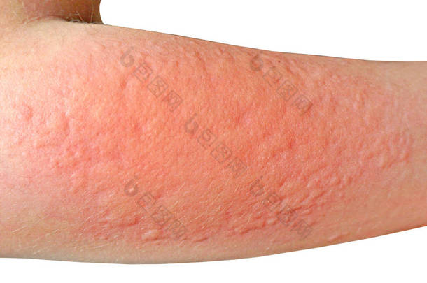 皮疹、过敏性接触性皮炎、对化学品过敏、因接触而感染真菌