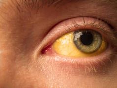 肝病、肝硬化、肝炎、胆红素等疾病眼巩膜的黄色染色