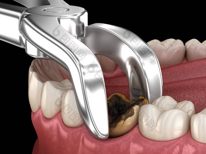 龋伤磨牙的拔牙.医学上准确的牙齿3D图像.