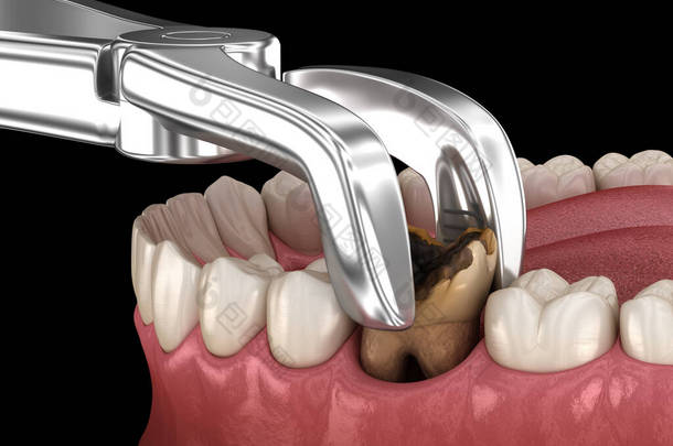龋伤磨牙的拔牙.医学上准确的牙齿3D图像.