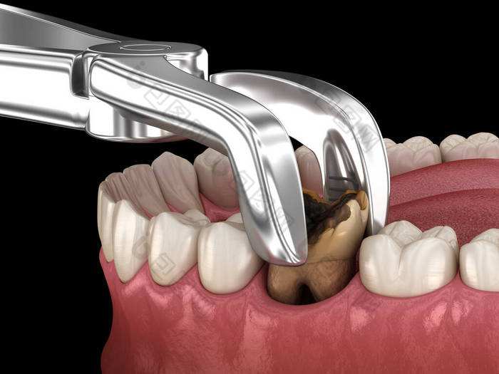 龋伤磨牙的拔牙.医学上准确的牙齿3D图像.