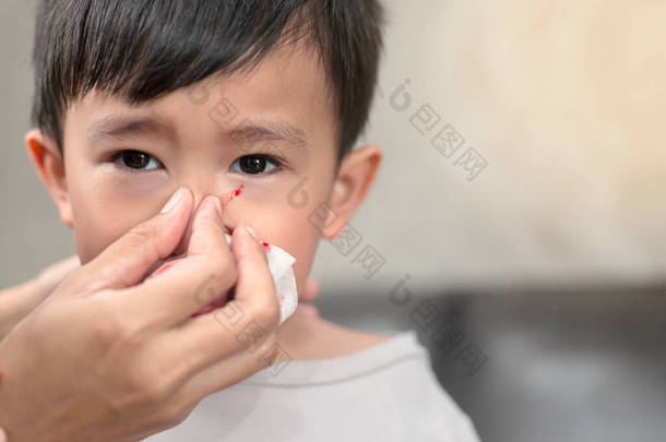可爱的亚洲裔流鼻血儿童的画像- -鼻出血急救的概念.