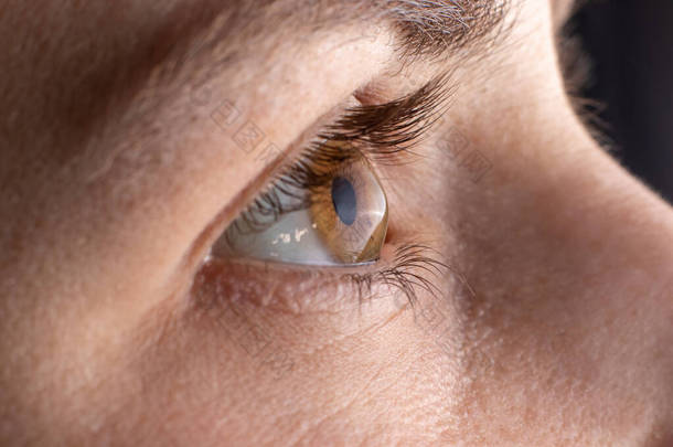 宏观的眼睛照片。眼角膜疾病:眼科疾病,眼角膜变薄,呈锥形.角膜塑料.