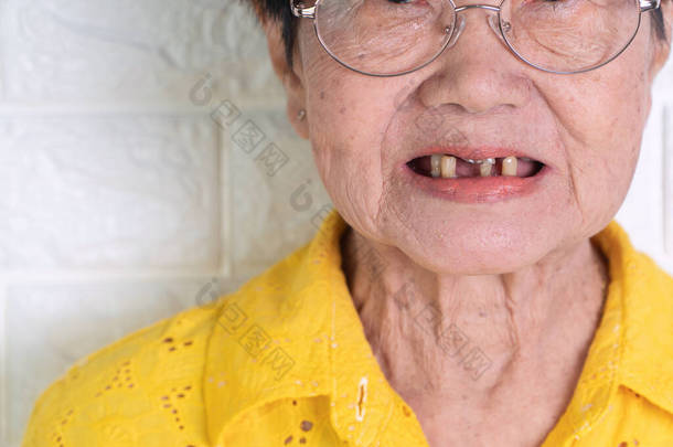 亚洲70多岁的老年妇女笑了，牙齿破了几颗，难以<strong>咀嚼</strong>老年人的食物。这里需要假牙来替换缺失的牙齿和帮助<strong>咀嚼</strong>食物.