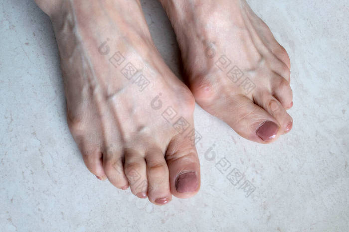 Hallux valgus，大的不正常的脚骨头。浅米色背景的雌性大脚尖上的骨头