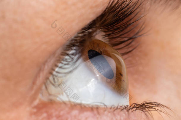 眼角膜，四度。角膜收缩以锥形、视力下降、散光的形式出现。宏观收尾