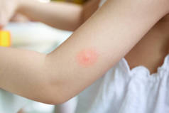 小女孩因蚊子叮咬而皮疹和过敏
