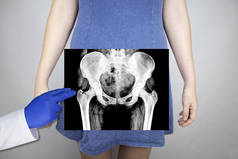 一个女人骨盆的X光照片放射学家检查X光检查。髋关节的照片被贴在病人的身体上.