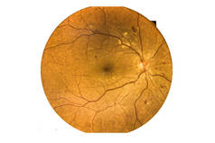 在白色背景下孤立的疯狂视网膜异常。糖尿病视网膜检查的医疗概念.