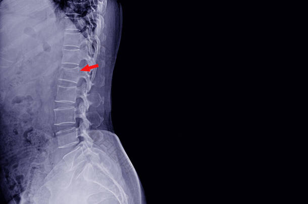 X线脊柱侧视病史1例男性意外和黑色疼痛，显示压迫性骨折体脊椎L1 。正常的椎间盘间隙和椎旁软组织。医学概念.