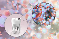 带有蛀牙的牙齿和引起蛀牙的微生物的特写，3D图解