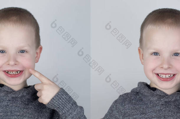 之前和之后。这孩子用龋显示受损的<strong>牙齿</strong>，在第二张照片中，牙医<strong>修复牙齿</strong>的工作。儿童龋病、治疗、康复