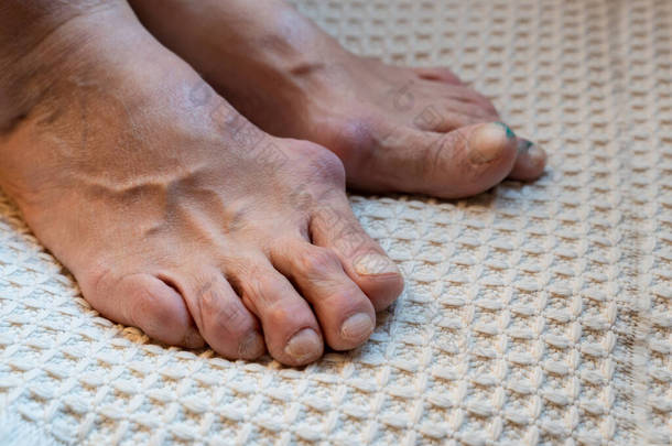 风湿性关节炎或年轻高加索妇女脚趾痛症。急性炎症性关节炎(一种红肿、嫩、热、肿的关节)的反复发作)