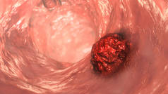 大肠癌，肠癌，肠道肿瘤，肠道肿瘤，显示肠道恶性肿瘤的三维图像
