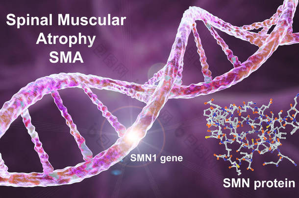 脊髓<strong>肌肉</strong>萎缩症（SMA）是一种遗传性神经<strong>肌肉</strong>疾病，由于SMN1基因的变异导致运动神经元的丧失，导致<strong>肌肉</strong>逐渐萎缩。