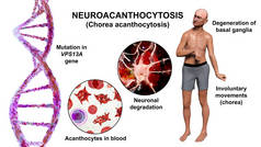 VPS13A基因突变引起的神经退行性疾病，即神经细胞病，其特征是血液中存在着无菌细胞，且有类固醇运动。