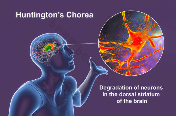 亨廷顿病<strong>患者</strong>大脑中突出的背侧纹状体、尾状核和putamen，以及神经元退化的特写，概念三维图解