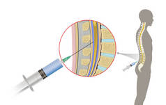 腰椎穿刺（英语：Lumbar puncture）也被称为脊柱穿刺（英语：spinal tap），是一种将针头插入脊柱管的医疗程序。脑脊液